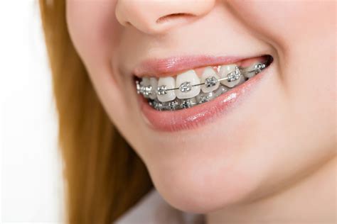 como son los brackets metalicos|brackets de metal.